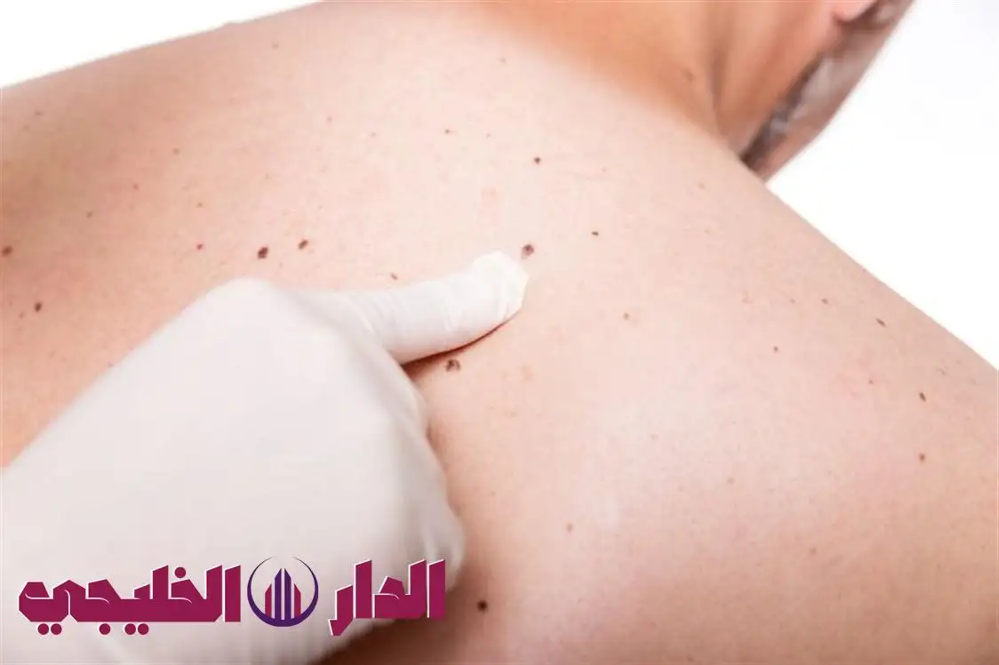     علامة على الجلد تكشف سرطاناً خبيثاً قبل فوات الأوان 